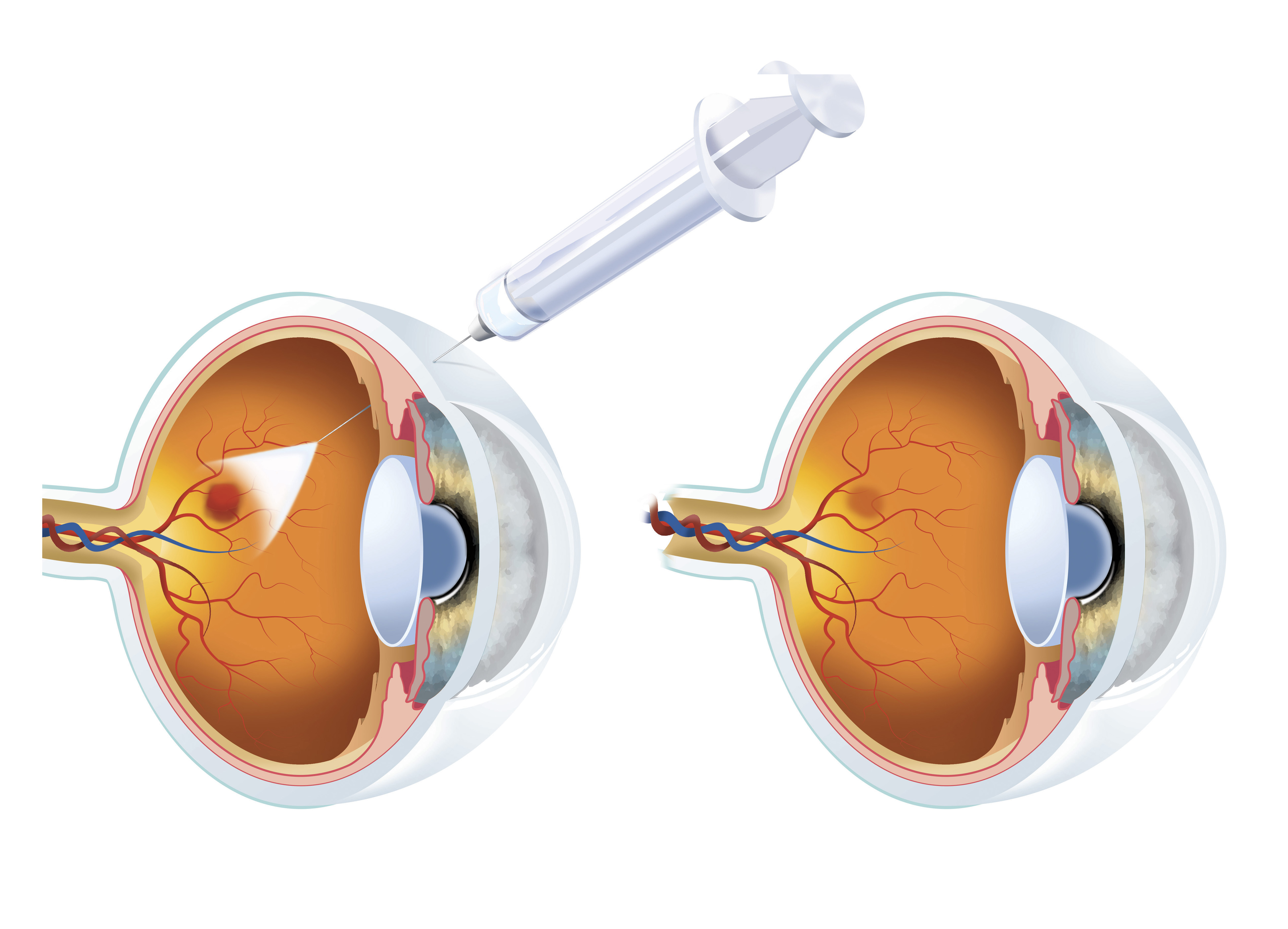 Вылечил сетчатку. Интравитреальное Введение ингибиторов ангиогенеза. Интравитриальное Введение анти-VEGF-препаратов. Инъекция в глаз макулодистрофия сетчатки.